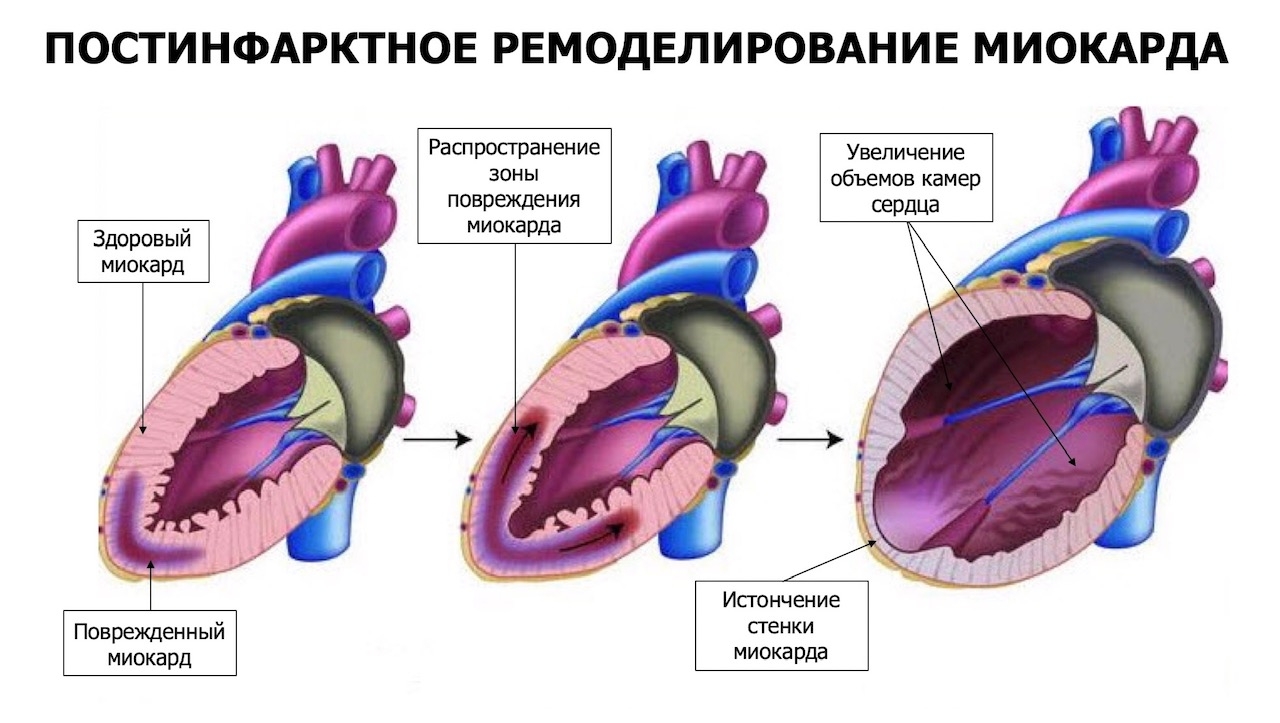 Инфаркт левого. Инфаркт миокарда ремоделирование левого желудочка. Ремоделирование сердца патофизиология. Концентрический Тип ремоделирования миокарда. Механизмы ремоделирования миокарда.